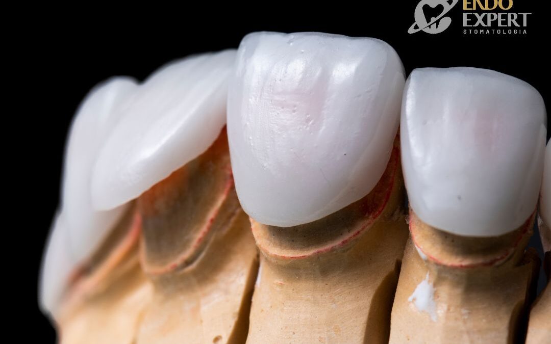 Licówki zębowe Katowice Brynów Ceramiczna od 2400 zł