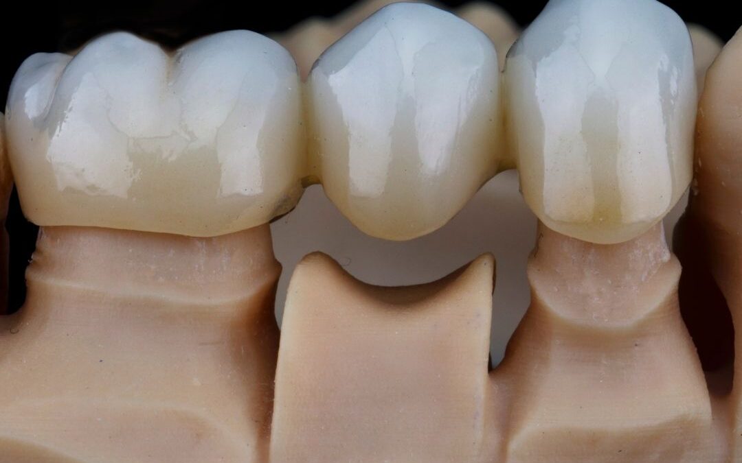 Most protetyczny Katowice Brynów