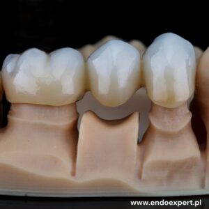 Most protetyczny Katowice Brynów