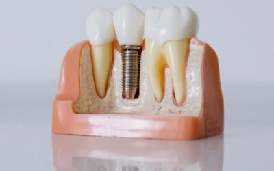 Dlaczego implant zęba nie zawsze się przyjmuje?