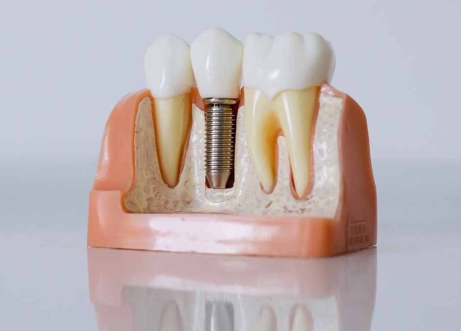 Dlaczego implant zęba nie zawsze się przyjmuje?