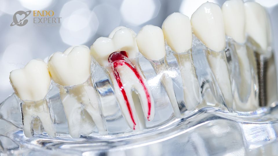 Kiedy leczenie kanałowe się nie udaje — możliwe powikłania i co dalej?