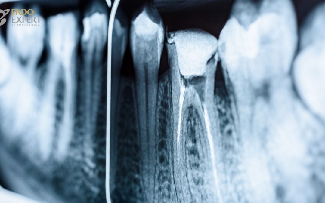 Reendo, czyli powtórne leczenie kanałowe. Czy można uratować źle wyleczony ząb?