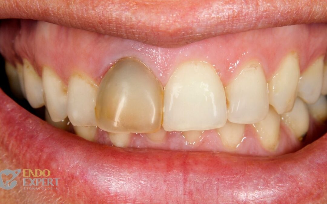 Mit martwego zęba: Dlaczego kanałowy ząb ciemnieje i jak przywrócić mu blask?