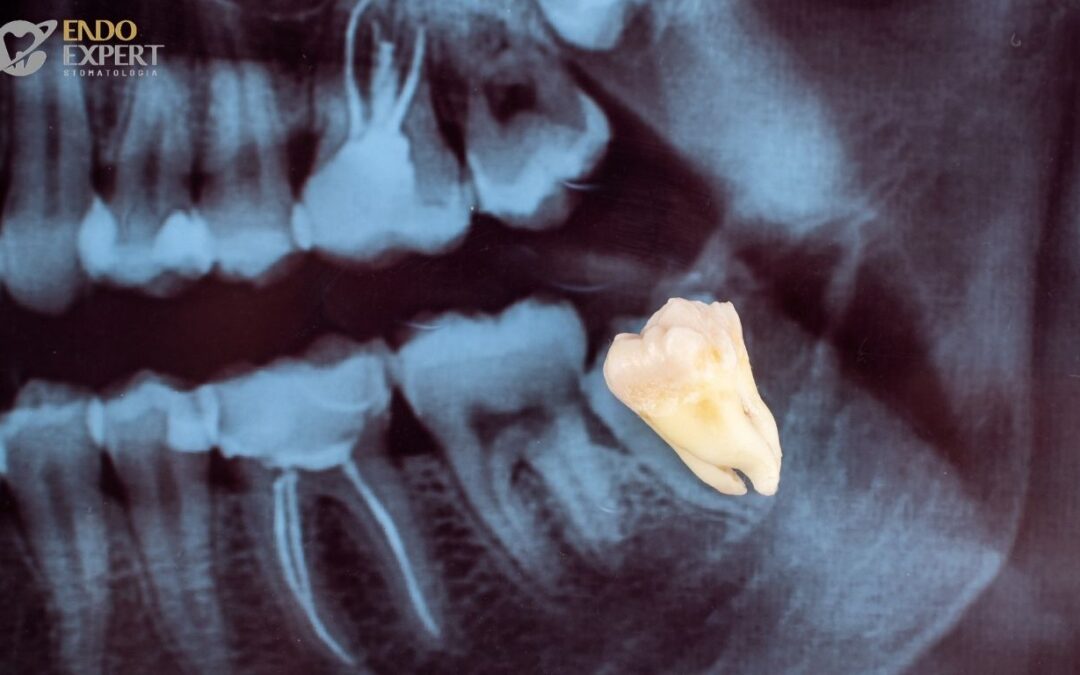 Usuwanie ósemek Katowice