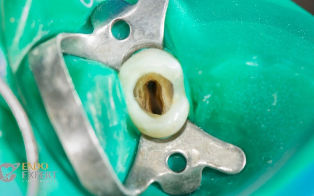 Złamane narzędzie w kanale zęba – czy to wyrok? Jak mikroskop ratuje zęby skazane na usunięcie.