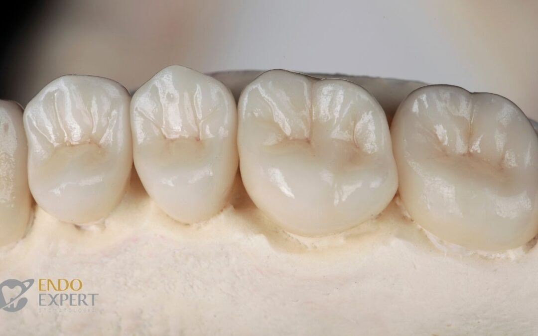 Nieszczelny most protetyczny – objawy, których nie powinieneś ignorować